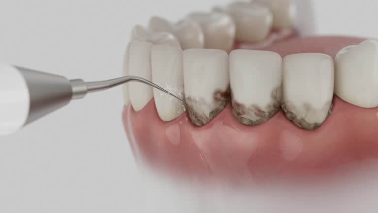 Trusted Wisdom Tooth Removal service in Preston, ID - Dentist Open Now